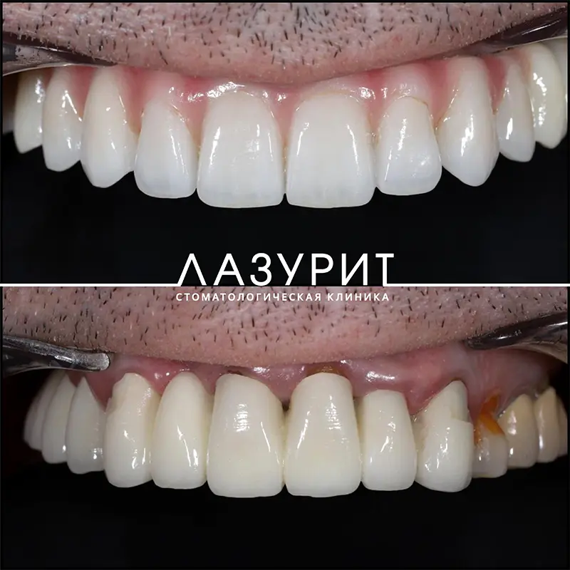 Результат лечения All-on-4: разрушение зубов