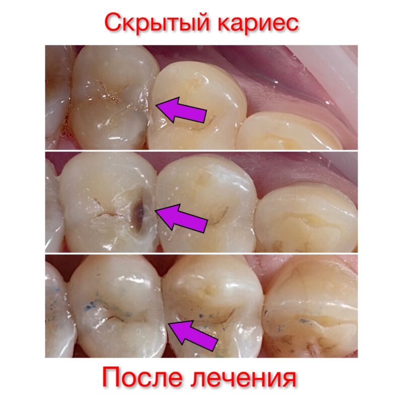 ЧЕМ ОПАСЕН СКРЫТЫЙ КАРИЕС? ИСТОРИЯ НАШЕГО ПАЦИЕНТА, КОТОРЫЙ СЧИТАЛ, ЧТО ОН ПОЛНОСТЬЮ ЗДОРОВ!