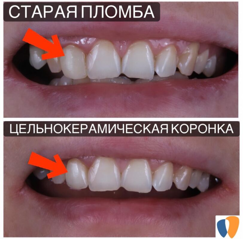 ЦЕЛЬНОКЕРАМИЧЕСКАЯ КОРОНКА EMAX – ОТЛИЧНЫЙ ВЫБОР!
