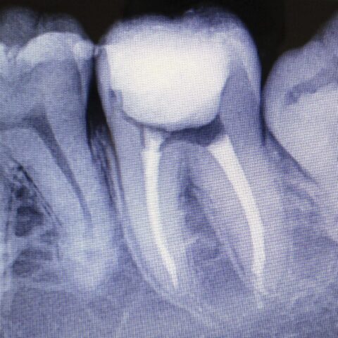 ПЕРИОДОНТИТОМ
